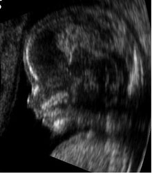 ultrazvuk bebe u trudnoci